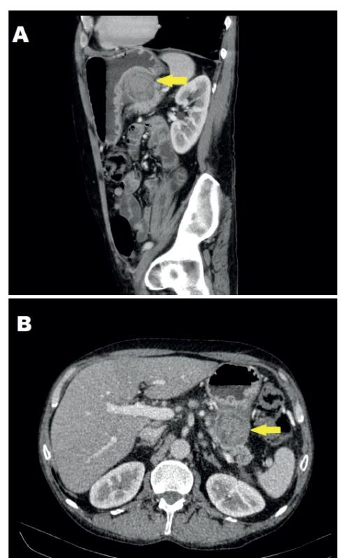 CT obraz suspektní léze sagitální řez (A) a tansverzální
řez (B)<br>
Fig. 1: CT scan of the suspected lesion from the sagittal
(A) and transversal view (B)