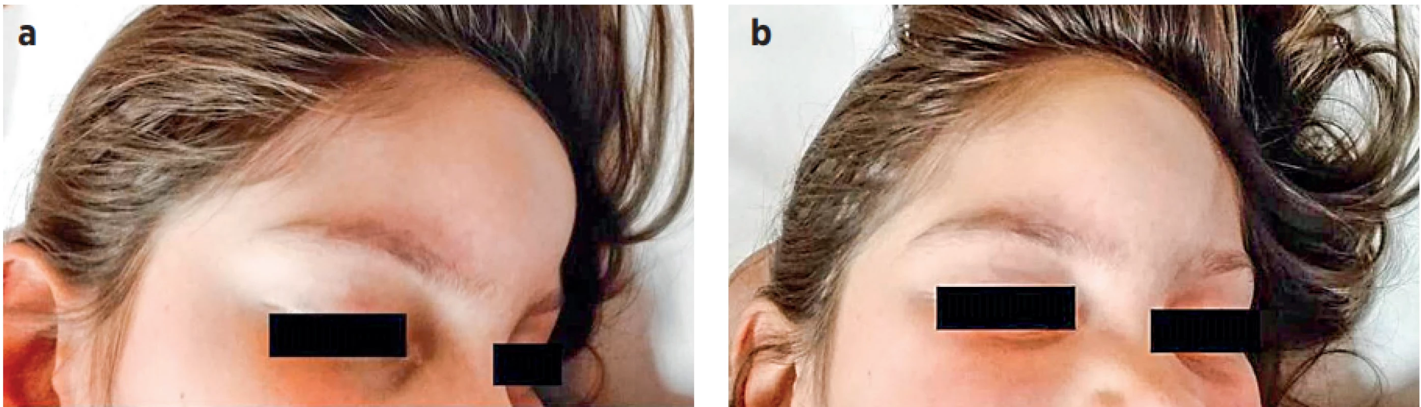 a, b (P1). Fluktuující rezistence v oblasti čela při subperiostálním abscesu frontální kosti. (Se souhlasem z archivu MUDr.
Jany Hrubé)<br>
Fig. 1a, b (P1). Fluctuant resistance in the forehead due to the subperiosteal abscess of the frontal bone. (Dr. Jana Hrubá’s 
archive, with her approval)