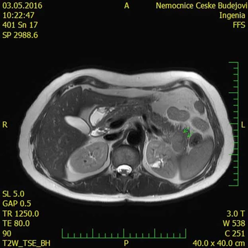 Intrapankreaticky uložená akcesorní slezina (IPAS) na magnetické rezonanci
(šipky).
Fig. 4. Magnetic resonance imaging scan showing an intrapancreatic accessory
spleen (IPAS) (arrows).