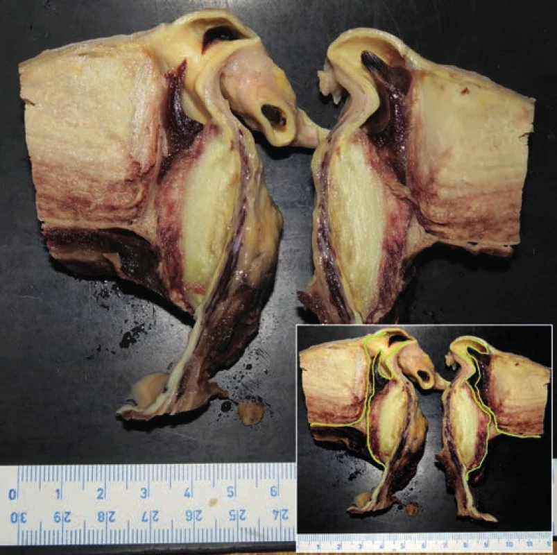 Transverse cut through brachiocephalic trunk and aortic intramural
thrombus. Yellow lining is showing the course of pseudocanal connecting
lumen of the aorta with brachiocephalic trunk.