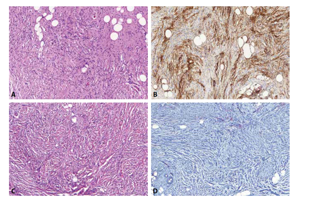 CD34 pozitivní buňky v neurofibromech (A) odpovídají fibroblastům a tvoří zde jakousi síťovitou strukturu, která je dobře patrná právě
v tomto barvení (B). Při nádorové progresi do atypického neurofibromu (C) a low-grade maligního tumoru z pochev periferních nervů dochází ke
změně architektoniky původního neurofibromu. To vede i ke ztrátě této CD34 pozitivní síťovité struktury (D), což je spolu s dalšími rysy považováno
za jeden z diagnostických znaků této progrese.