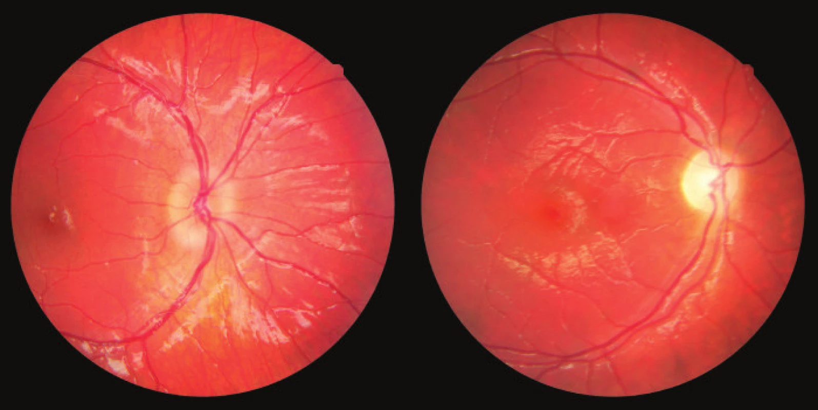 Photograph of fundus of OD: edema of papilla and
atrophy of papilla in patient with optic glioma
Source: Children’s Ophthalmology Clinic, Faculty of Medicine,
Masaryk University and University Hospital Brno
