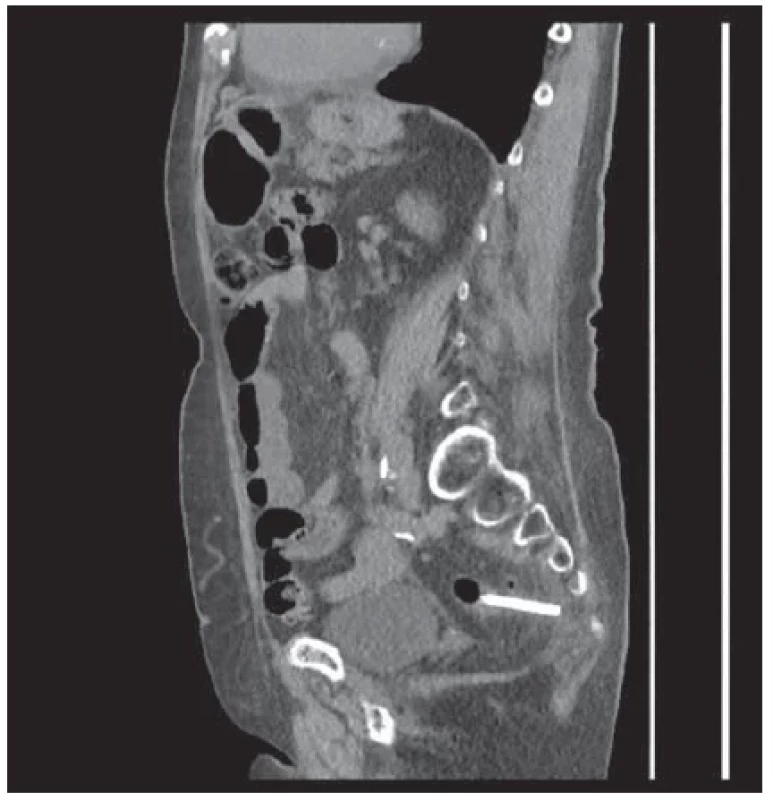 Sagitální rovina CT břicha/pánve, hyperechogenní cizí
těleso – stent v sigmatu. <br> 
Fig. 2. Sagittal plane CT of the abdomen/pelvis, hyperechoic foreign
body – stent in the sigmoideum.