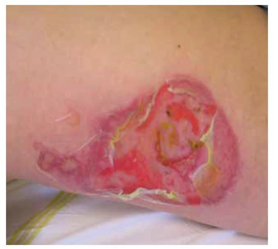 Pemphigus vulgaris, středně těžký