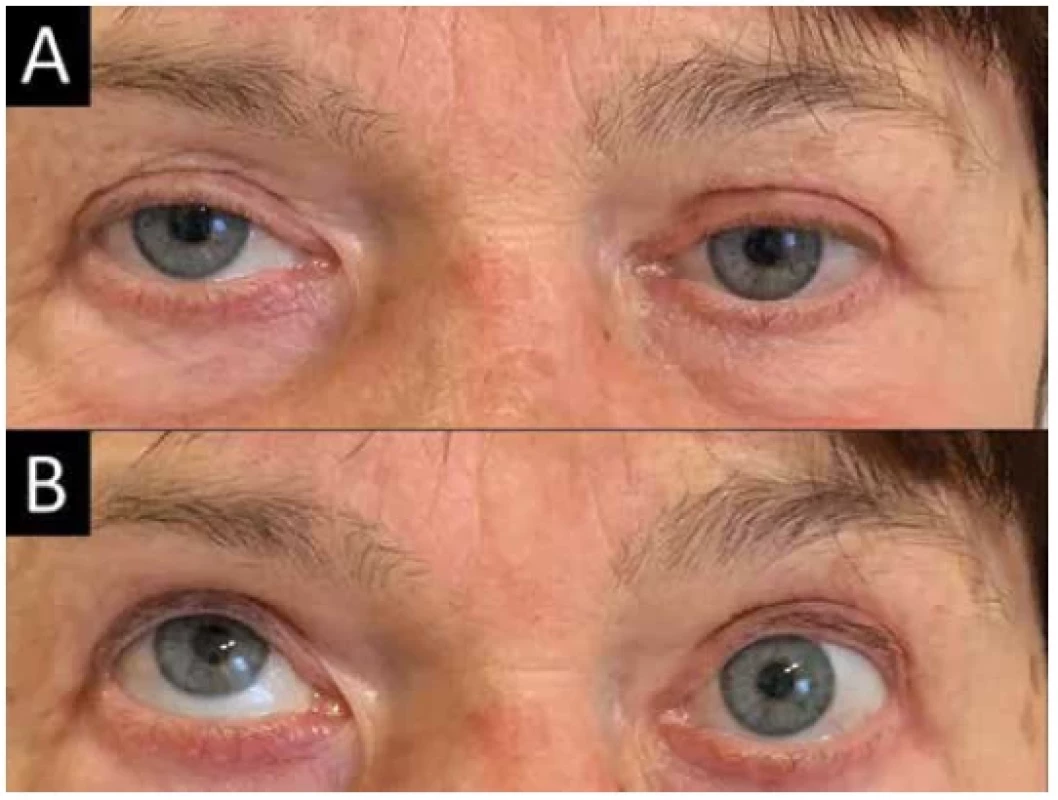 Patient with active form of thyroid-associated orbitopathy, already with diplopia in
forward gaze (A), in which slight hypotropia of the left eye is evident when looking up (B),
when limitation of elevation is noticeable in the left eye
