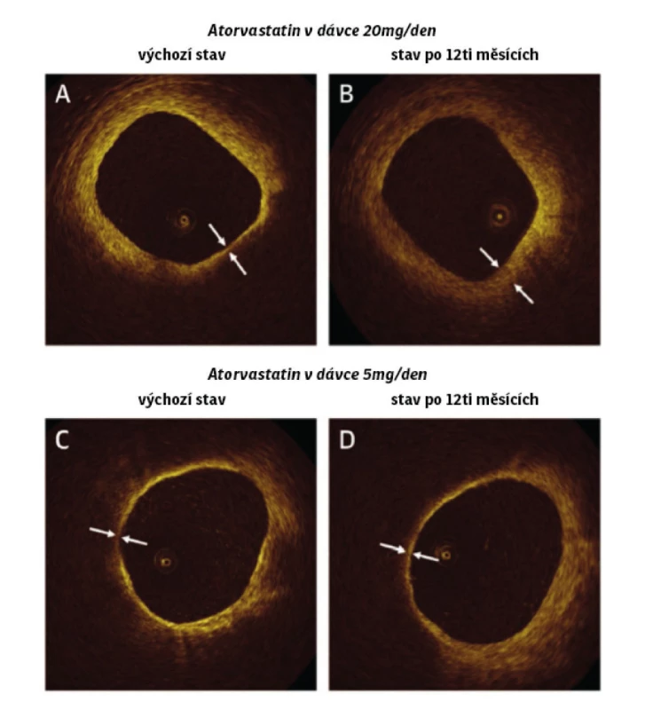 Studie EASY-FIT (zvětšení vrsty fibrózní čepičky koronárního plátu po
podávání 5 a 20 mg atorvastatinu). Upraveno dle Komukai et al. Change in
Plaque Characteristics with Atorvastatin. JACC VOL. 64 No 21, 2014: 2207–2217