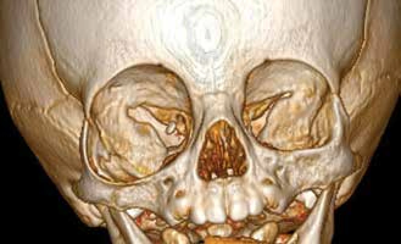 CT vyšetření v 9. měsíci věku s 3D rekonstrukcí
obličejového skeletu s patrným rozšířením pravé orbity