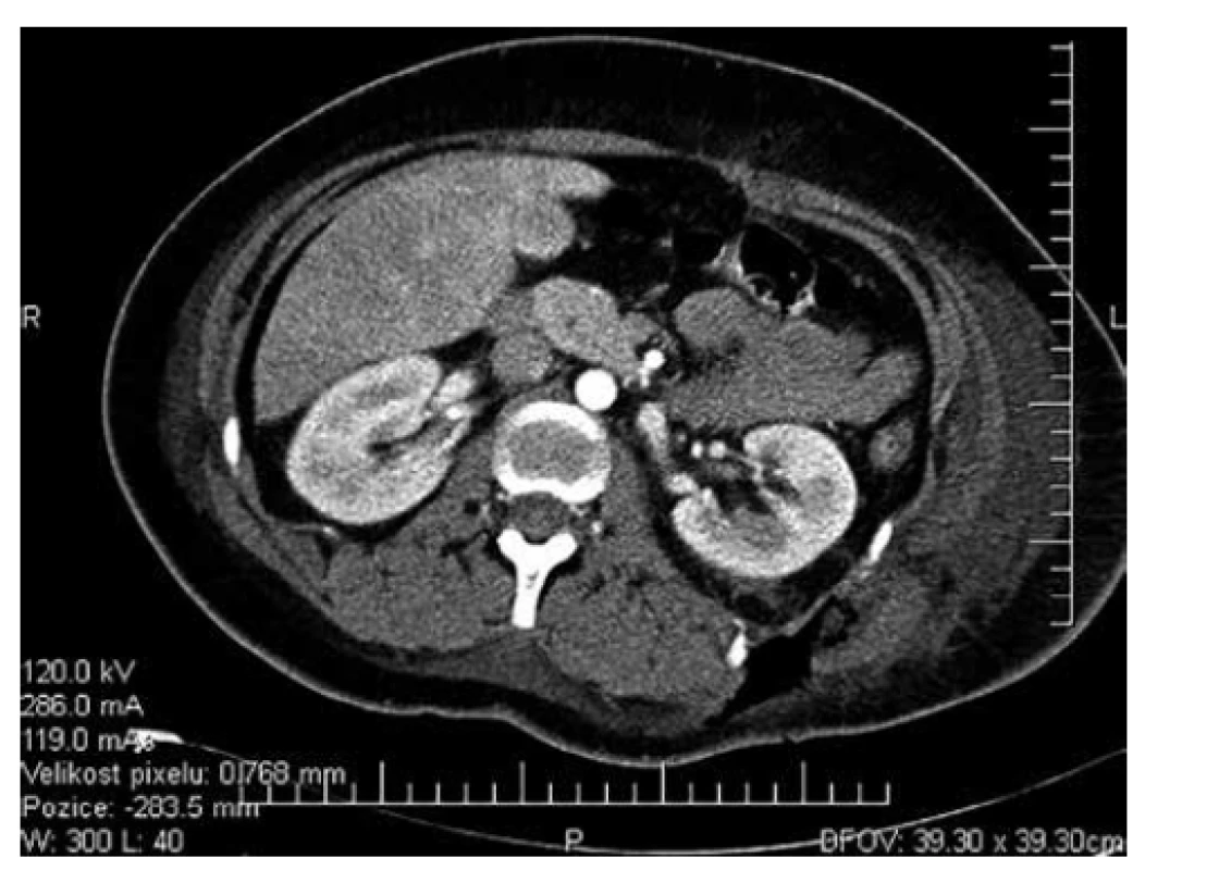 CT po incizi na lůžku<br>
Fig. 6: CT after performed bedside incision