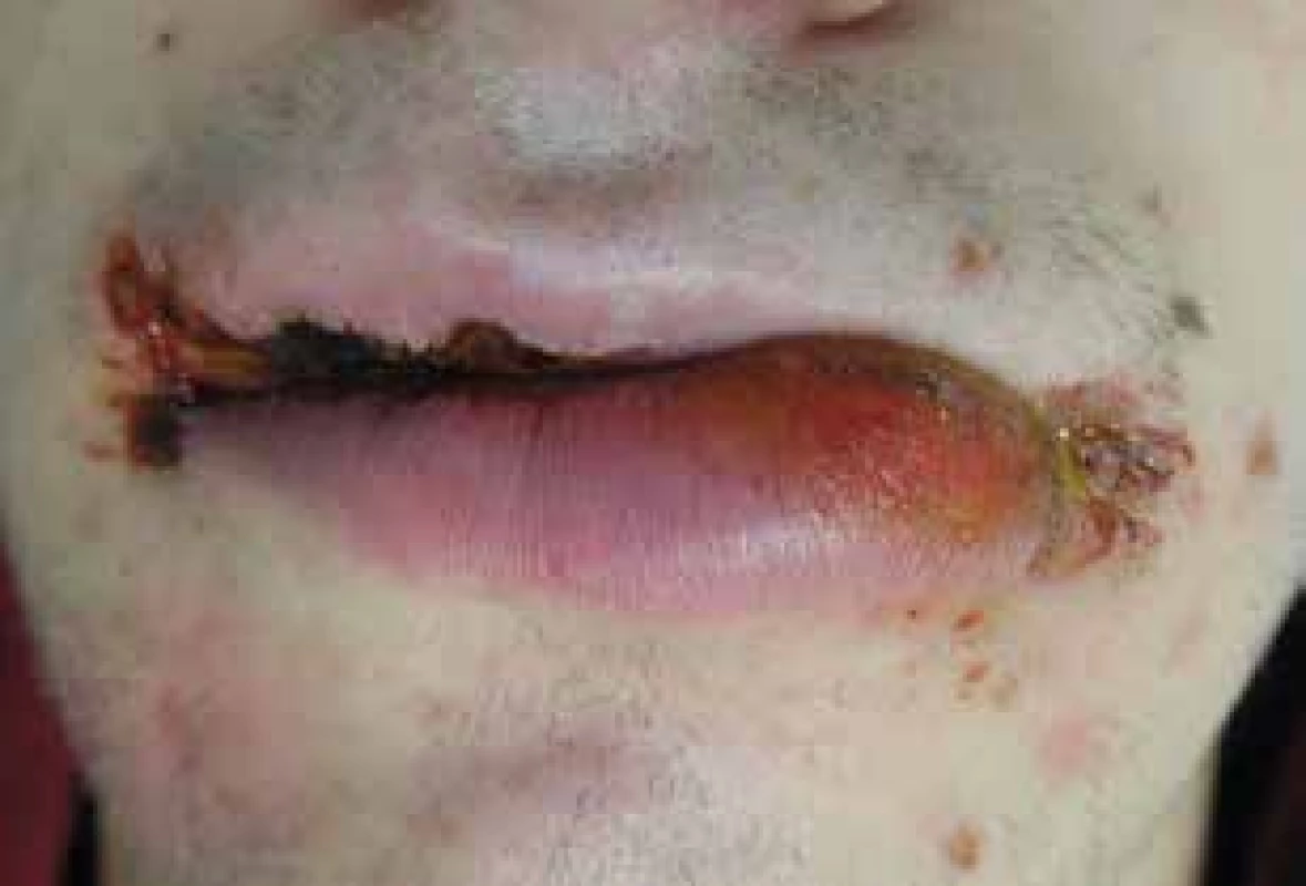 Impetigo