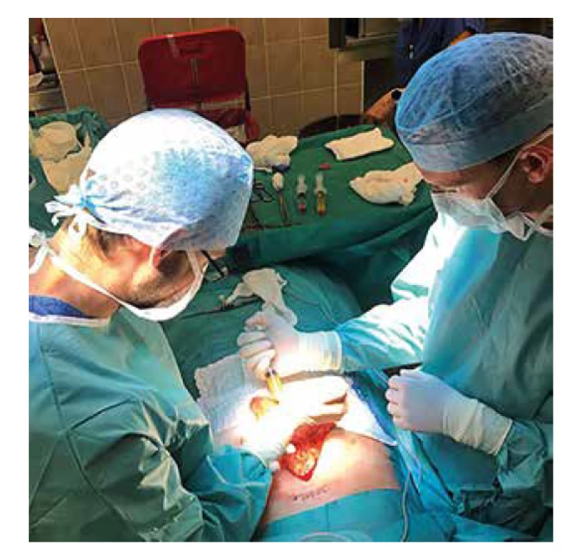 Laparotomický výkon, Langerhansovy ostrůvky
v plazmě příjemce jsou aplikovány na velké omentum
a překryty lidským trombinem<br>
Fig. 4: Laparotomic procedure; pancreatic islets resuspended
in recipient‘ s plasma are applied onto the greater
omentum and covered with human thrombin.
