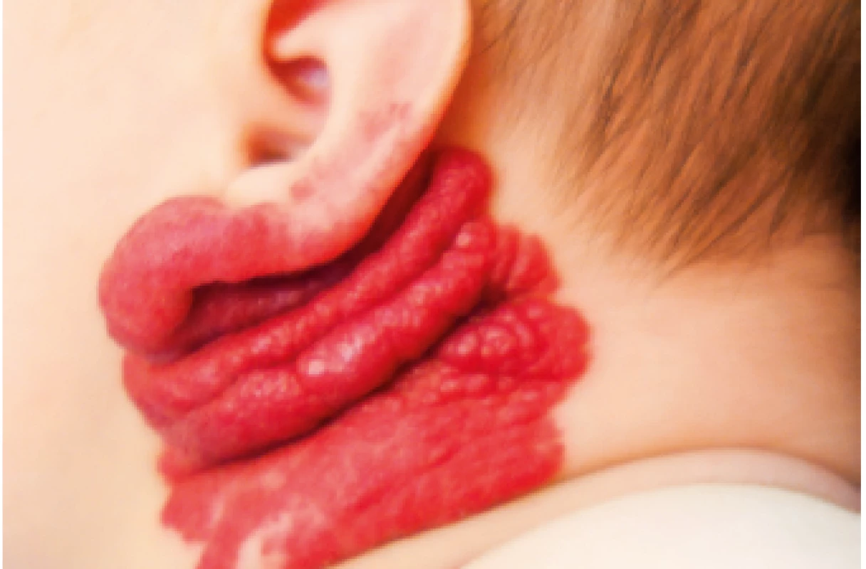 Rozsáhlý IH krku a boltce.<br>
Extensive neck and ear IH.