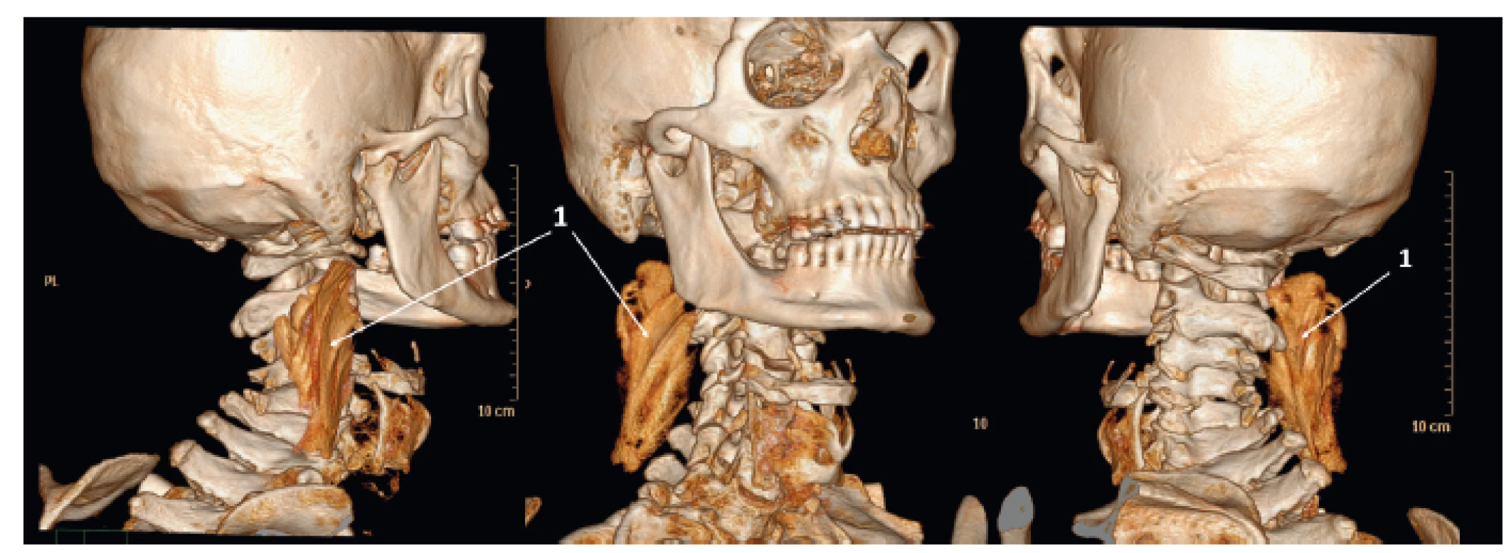 3D rekonstrukce šíření tekutiny po aplikaci 10 ml fyziologického roztoku do fasciálního prostoru mezi m. levator scapulae
(hypaxiální sval) a skupinu erektorů (epaxiální svaly)