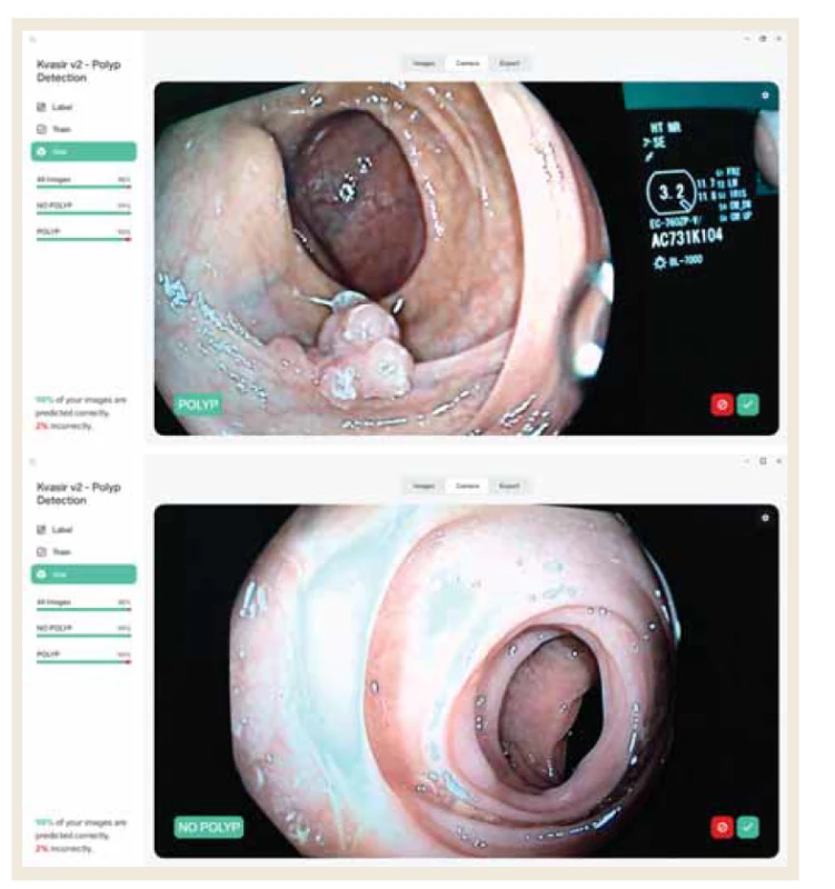 Reprezentativní příklad snímků s: A) nálezem polypu, B) bez nálezu
polypu.<br>
Fig. 2. Representative example of images with: A) finding a polyp, B) without finding
a polyp.