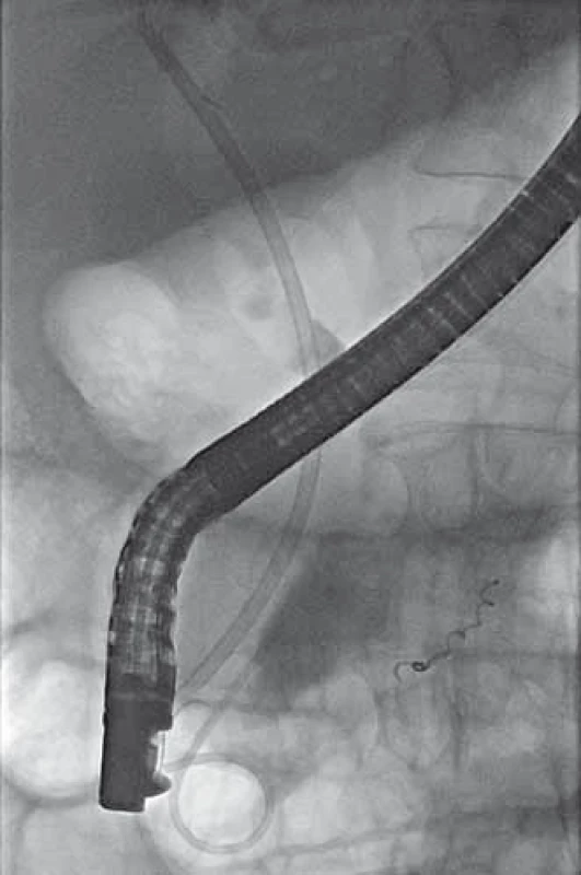 ERCP – traspapilárně zavedený
stent do d. choledochus a mono
pigtail do dutiny pseudocysty.
Fig. 5. ERCP – transpapillary stent
placement into common bile duct
and mono pigtail stent placement into
the pseudocyst cavity.