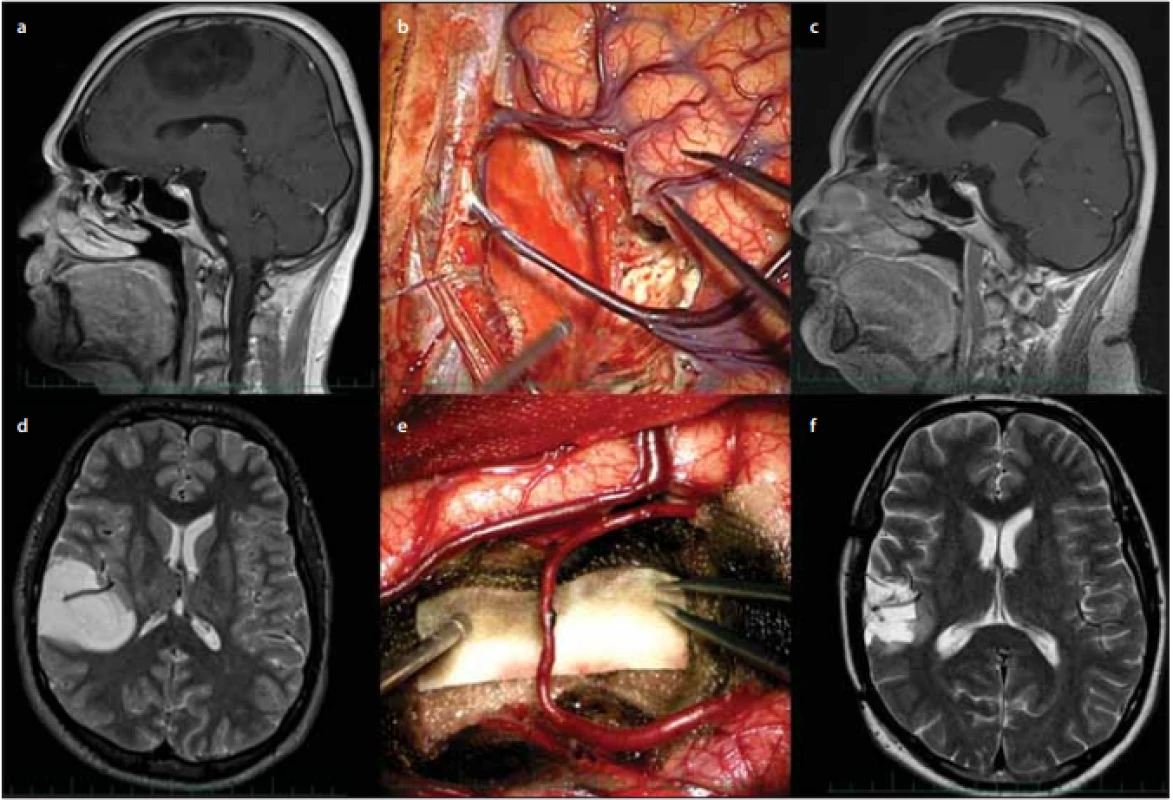 Zachování důležitých cévních struktur během operace nízkostupňového gliomu.<br>
Fig. 3. Sparing of important vascular structures during low grade glioma surgery. 