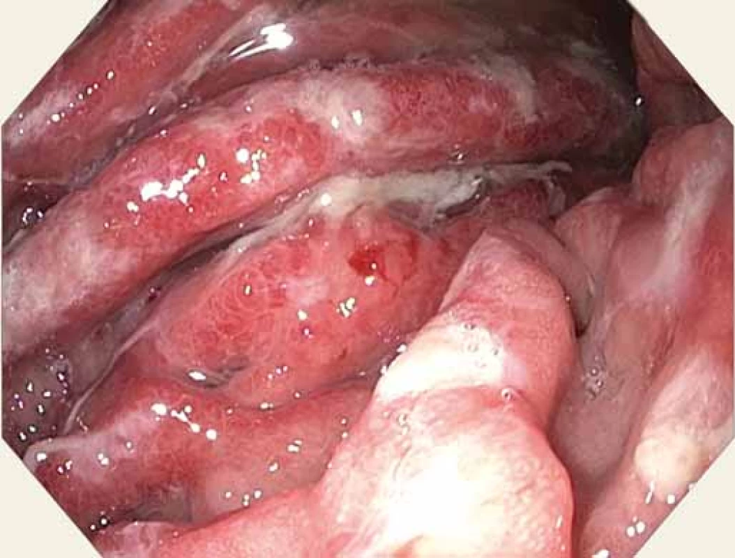 Sliznice žaludku – velká křivina – tuhé navalité
řasy, přechodné spontánní krvácení.<br>
Fig. 3. Gastric mucosa – greater curvature – rigid mucosa,
transient spontaneous bleeding.