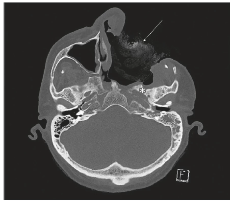 CT projekce, pooperační stav, trepanační dutina vyplněná
tamponádou (viz šipka), zadní hranice resekce při foramen
ovale (viz *).