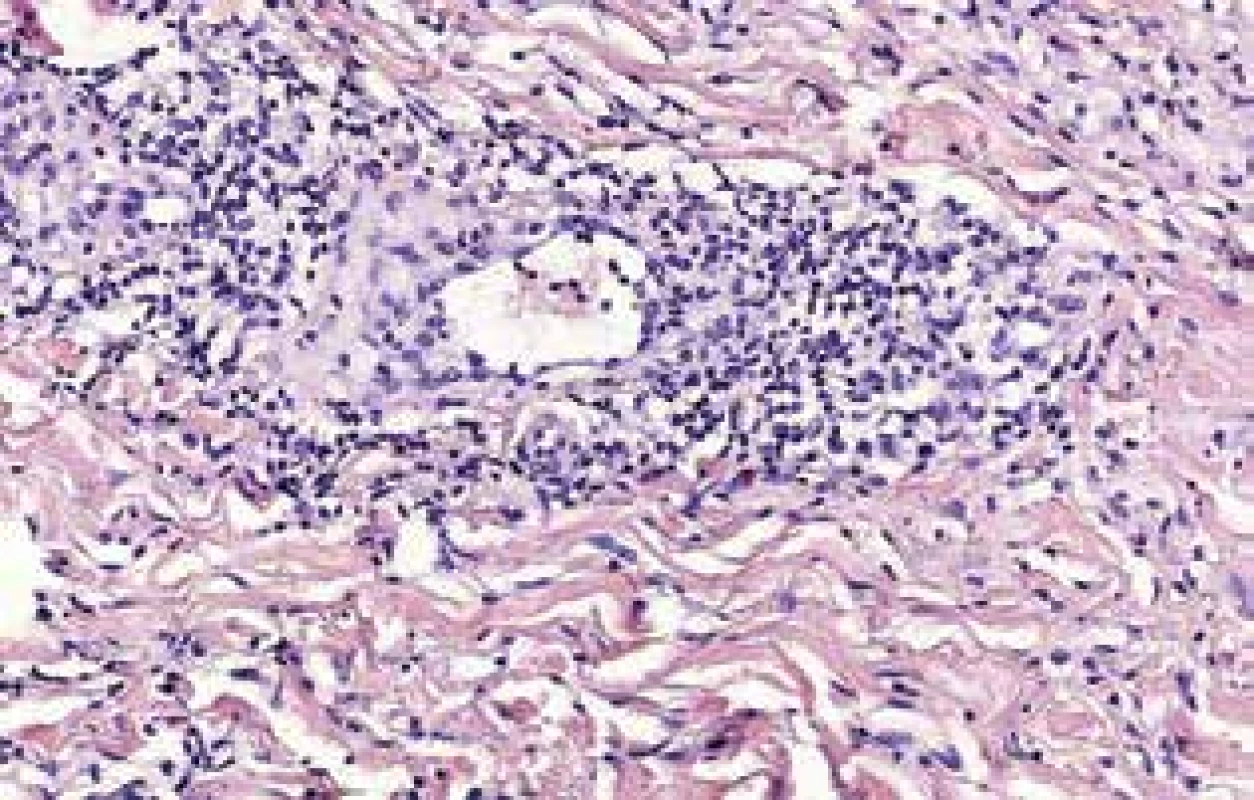 Histologický obraz ACA – biopsie z dorza pravé ruky
Hluboký perivaskulární a  intersticiální infiltrát lymfocytů
s plazmocyty a sklerotizace kolagenního vaziva.