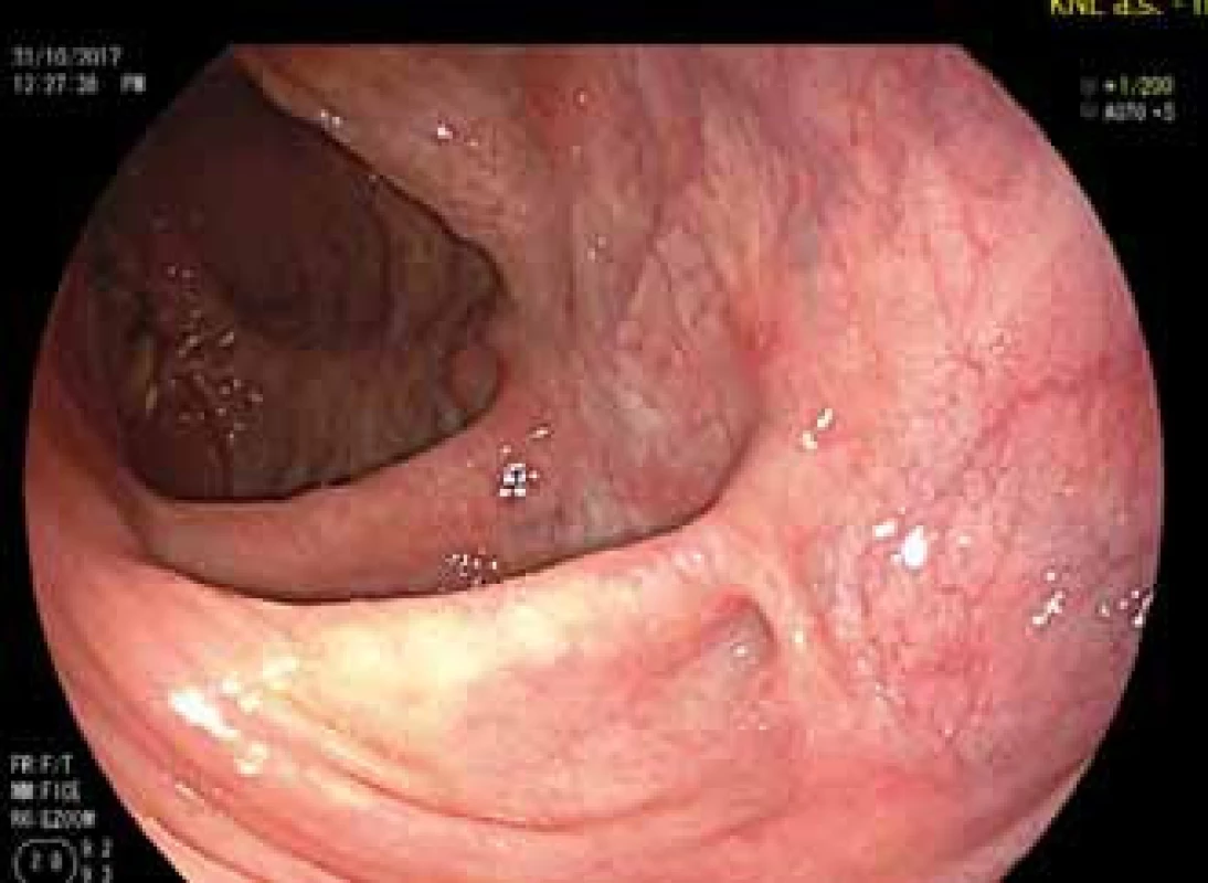 Pahýl rekta během léčby
ustekinumabem.<br>
Fig. 3. The rectal stump during
treatment with ustekinumab.