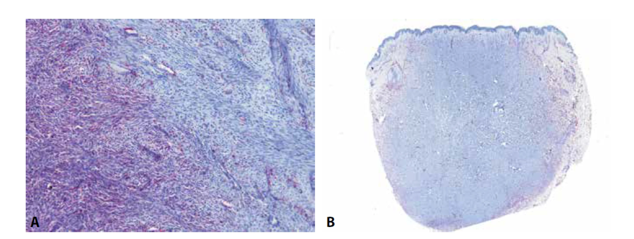 U dermatofibrosarcoma protuberans (DFSP) je možné pozorovat difúzní expresi CD34 v low-grade oblastech (A - vlevo) a její ztrátu v převážně
fascikulárně rostoucích high-grade oblastech (A – vpravo). Ke ztrátě exprese v těchto partiích dochází ve zhruba polovině případů a může
být nápomocná ke stanovení diagnózy fibrosarkomu ex DFSP. Protilátka CD34 je též užitečná k odlišení DFSP od benigního fibrózního histiocytomu.
U fibrózních histiocytomů, zejména pak u jeho celulárních forem, je exprese CD34 někdy také přítomna, ale téměř vždy pouze na periferii
tumoru, zatímco v jeho centru, na rozdíl od DFSP, chybí (B).