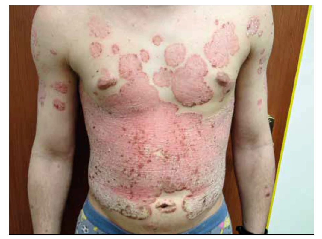 Těžká forma ložiskové psoriázy u 15letého chlapce. [Foto: archiv autorky]