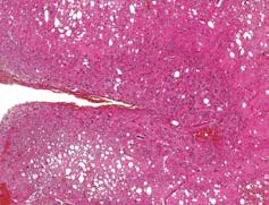 Dysorganizace vrstev mozečkové kůry,
rozšířením stratum granulosum a stratum
moleculare, hematoxylin-eosin, 100x.