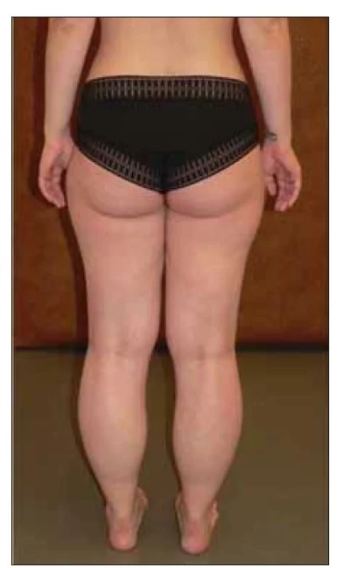 Pacientka LGMD R9 FKRP-related –
typická pseudohypertrofie lýtek.<br>
LGMD – pletencové svalové dystrofie<br>
Fig. 3. Female patient with LGMD R9
FKRP-related – typical pseudohypertrophy
of the calves.<br>
LGMD – limb girdle muscular dystrophy;