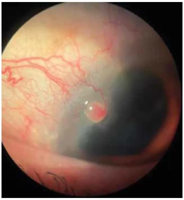 Salmon pink nodule with smooth surface and feeder
vessels from the nearby conjunctiva on the supratemporal region
of the cornea after cataract surgery