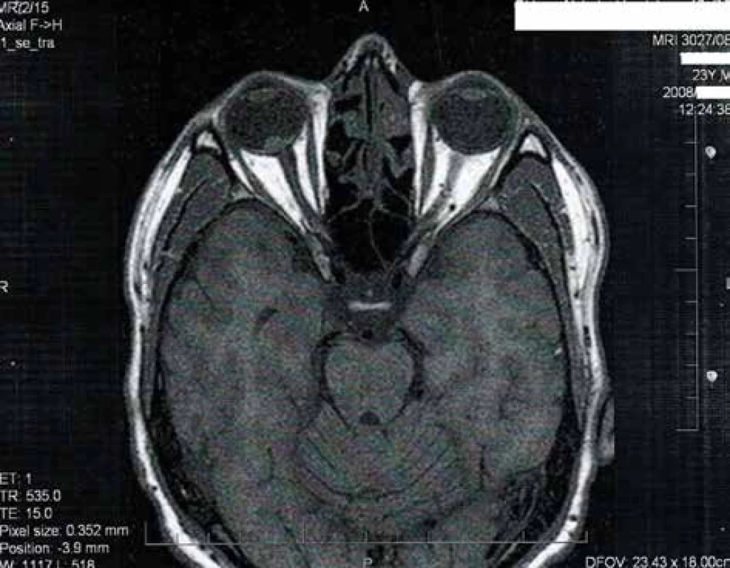 MRI obraz nádorového ložiska v blízkosti nad terčom zrakového nervu
v r. 2008