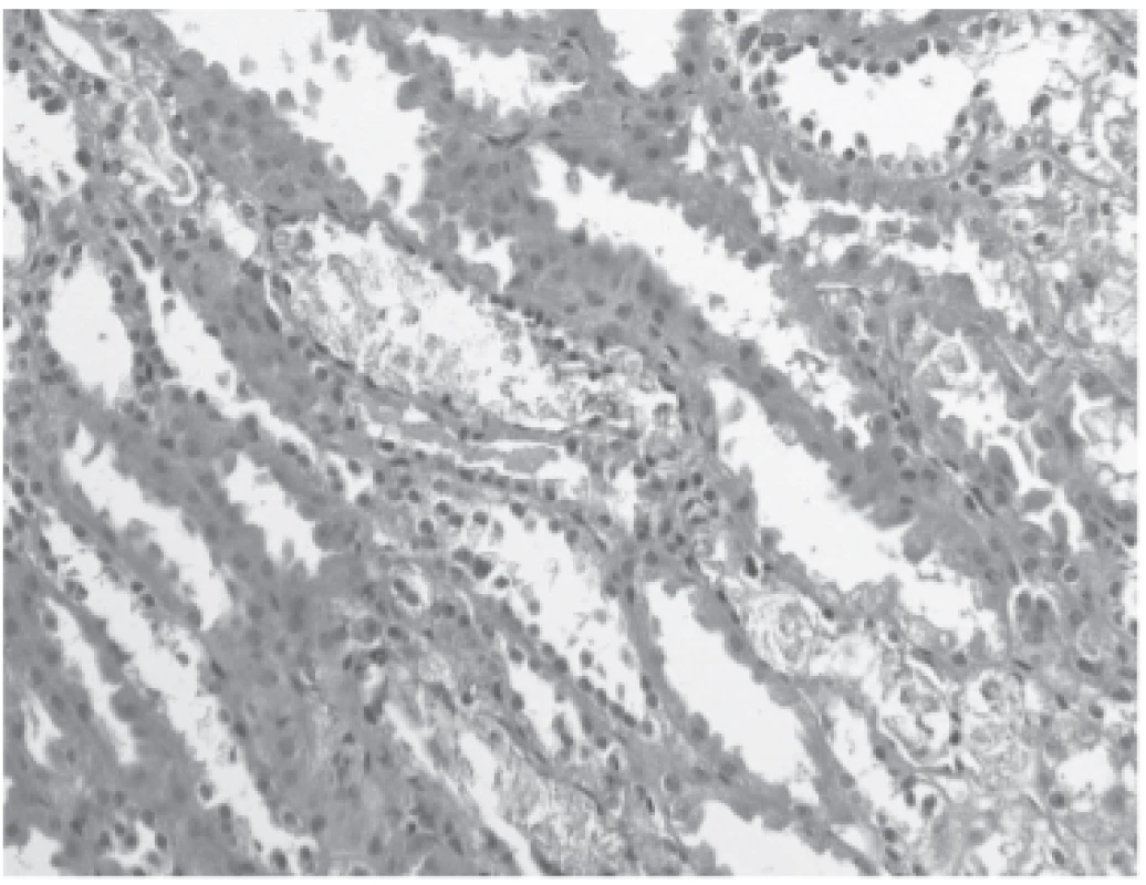 Renal tubules with flattened lining and ATN morphology, copious amount of calcium-phosphate microcalculi in
the lumen (hematoxylin and eosin staining with elastic).