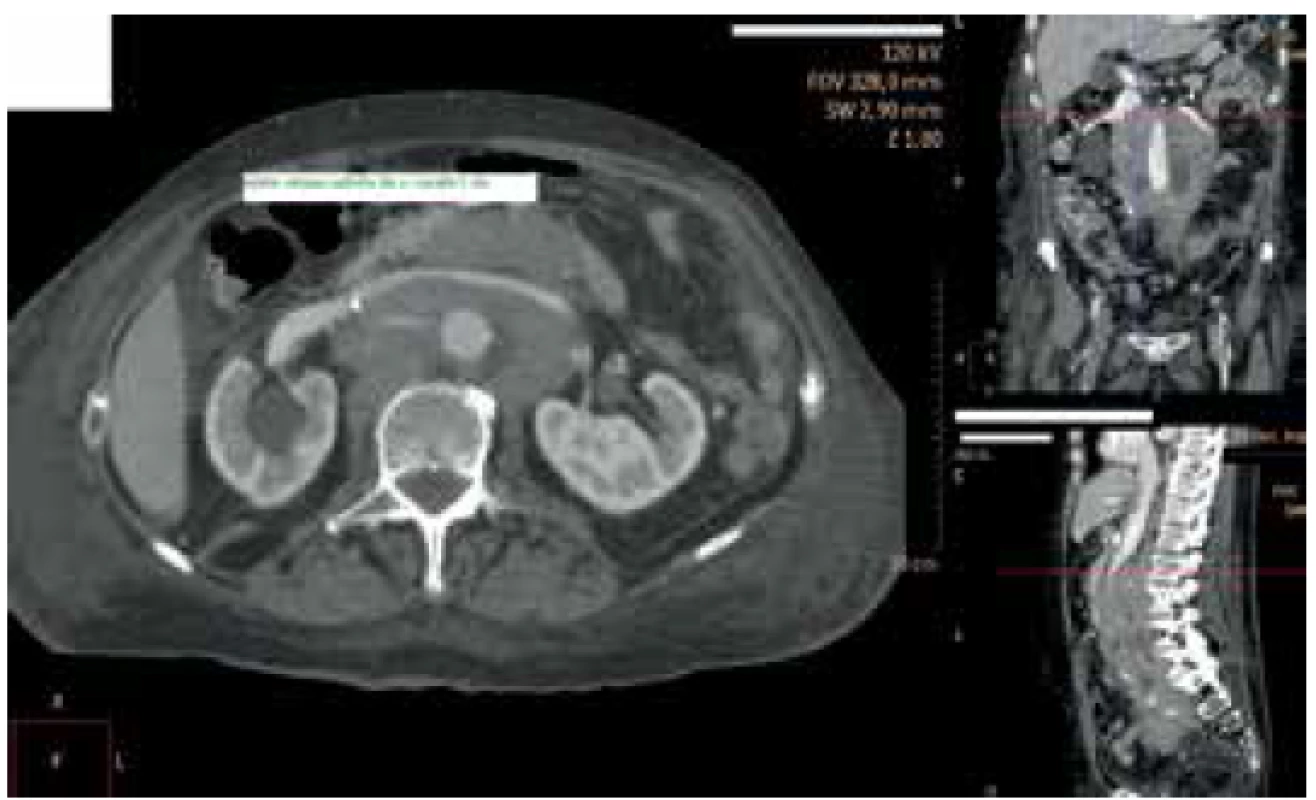 Oblast vstupu stentu do v. renalis l. dx.<br>
Fig. 3. Double J stent entry point into the right renal vein