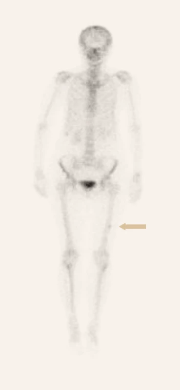 Kostní scintigrafie 99mTc značeným oxidronátem disodným (5. 8. 2019 po 6 měsících léčby): regrese ložiskového zvýšení metabolické aktivity ve střední třetině levého femoru