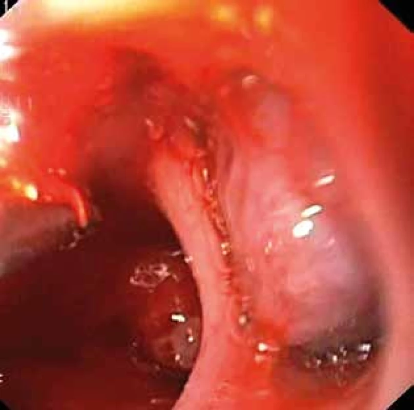 Tumor v divertiklu distálního jícnu <br>Fig. 8: Tumour in the diverticulum of the distal oesophagus