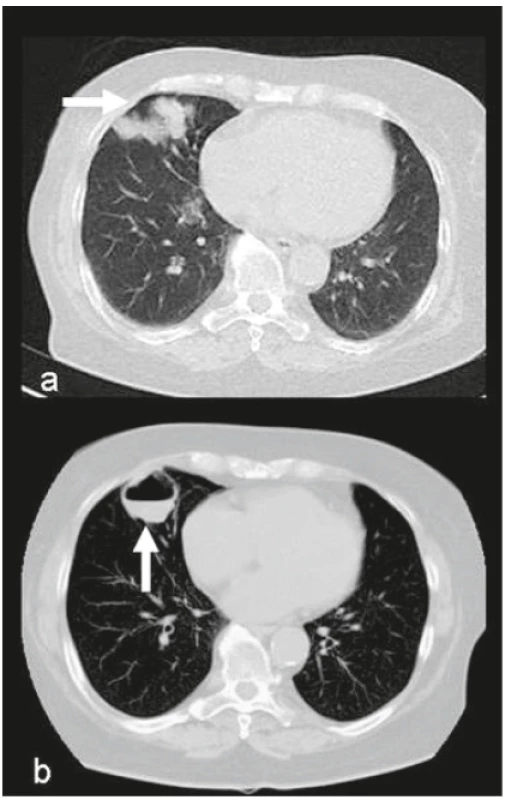 Revmatoidní plicní nodulóza s kavitacemi a tekutinovou
kolekcí u 72leté ženy s RA stupeň IV (RFs izotypy/IU/ml: -IgA: 984,
-IgM: 110, -IgG: 47, aCCP2: 4306,9 U/ml), Quantiferon negativní,
aspergilus negativní, kultivace aspirátu: sterilní. Febrilní ataky se
synkopami – ATB, HCQ 400 mg.<br>
a – HRCT plic: vícečetná kulovitá ložiska ve středním laloku (→)
– revmatoidní uzly, b – CT plic: splynutí menších ložisek s jejich
rozpadem vznik kaverny s hladinkou (↑) (vstřícně zapůjčeno z archivu
RDG oddělení nemocnice v Rychnově nad Kněžnou, Archiv
Radiologické kliniky LF UK a FN Hradec Králové s laskavostí MUDr.
J. Brtkové)