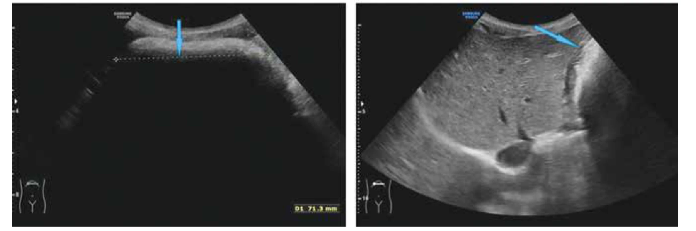 Nález při ultrazvukovém vyšetření u pacientky s trichobezoárem – žaludek s homogenně stínujícím obsahem (označen
šipkou).<br>
Fig. 1. Ultrasonographic finding in a patient with trichobezoar: gastric content shows homogeneous acoustic shadowing (marked
with an arrow).