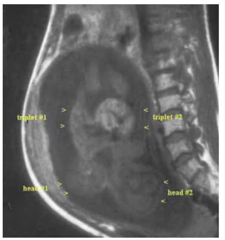 Magnetická rezonance, spojená trojčata [15].<br>
Fig. 8. Magnetic resonance imaging, conjoined triplets [15].