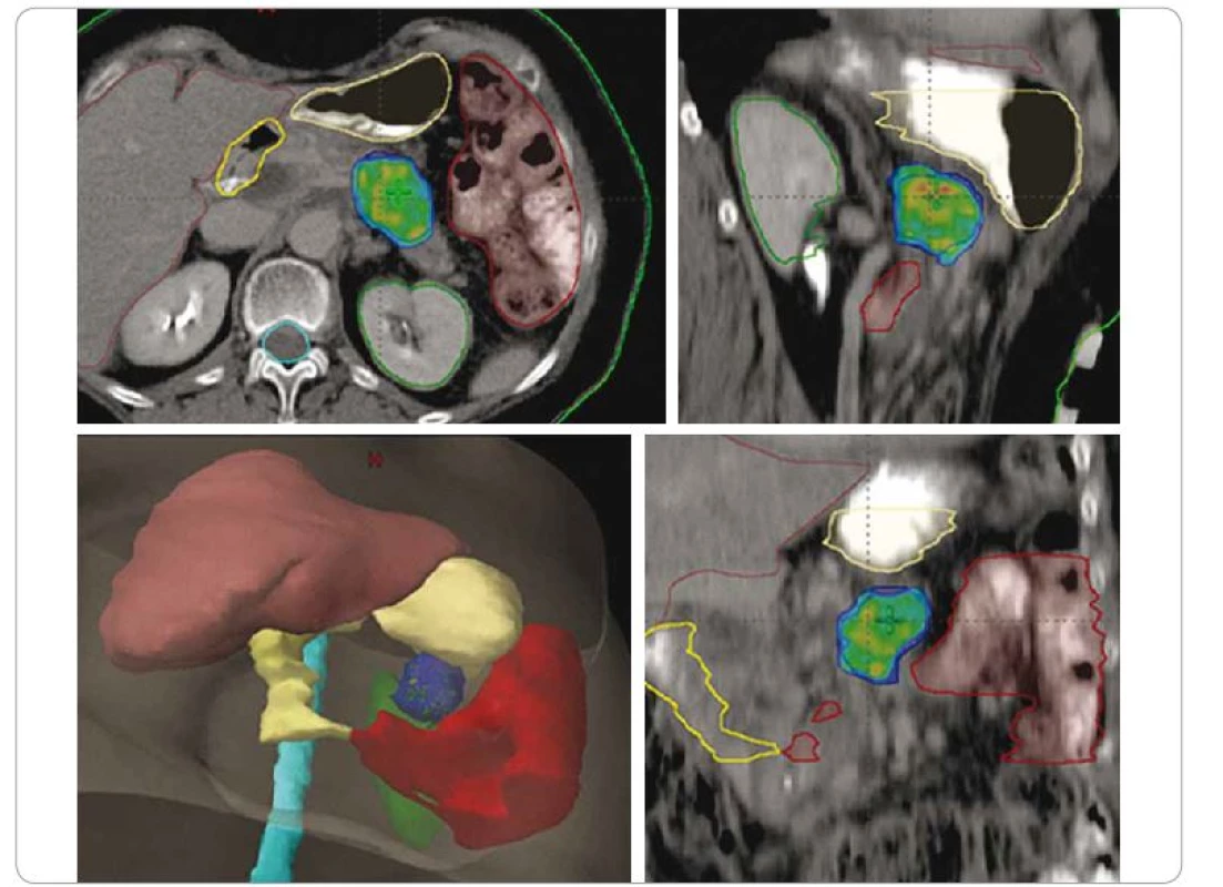 SBRT adenokarcinomu na pomezí těla a kaudy pankreatu u 67leté pacientky po neoadjuvantní chemoterapii. Technika SIB
– dávková eskalace v části ozářeného objemu, 25/33/36 Gy v 5 frakcích. Nález v hlavě pankreatu je dlouhodobě sledovaná cysta.<br>
SBRT – extrakraniální stereotaktická radioterapie, SIB – simultánní integrovaný boost, Gy – Gray