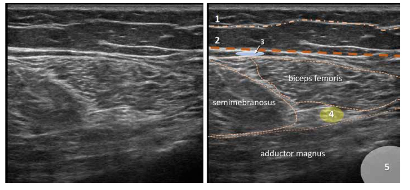 Nativní a kolorovaný ultrazvukový obraz zadní proximální části stehna. 1. povrchní fascie, 2. fascia lata, 3. místo pro aplikaci lokálního anestetika
pro blokádu NCFP, 4. n. ischiadicus, 5. femur