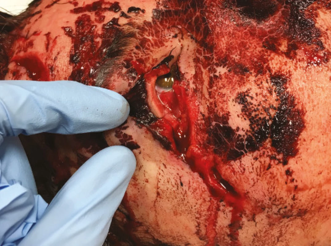 a. Open wound of outer corner, including torn lower canthal ligament. Patient after traffic accident