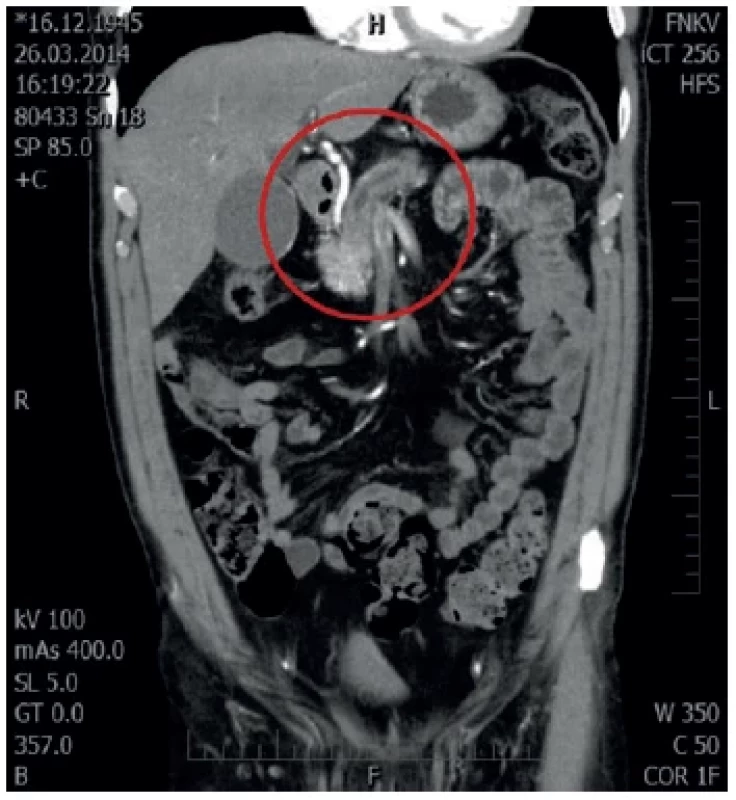 MDCT s nálezem duble duct sign
V červeném kruhu dilatace d. Wirsungi. <br> 
Fig. 3: MDCT with double duct sign
Dilatation of the pancreatic duct is captured in the red circle.