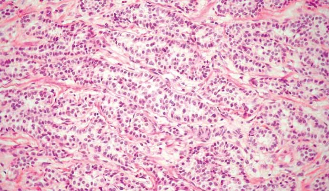 Neuroendokrinný nádor G2. Hematoxylín eozín, 400×.
