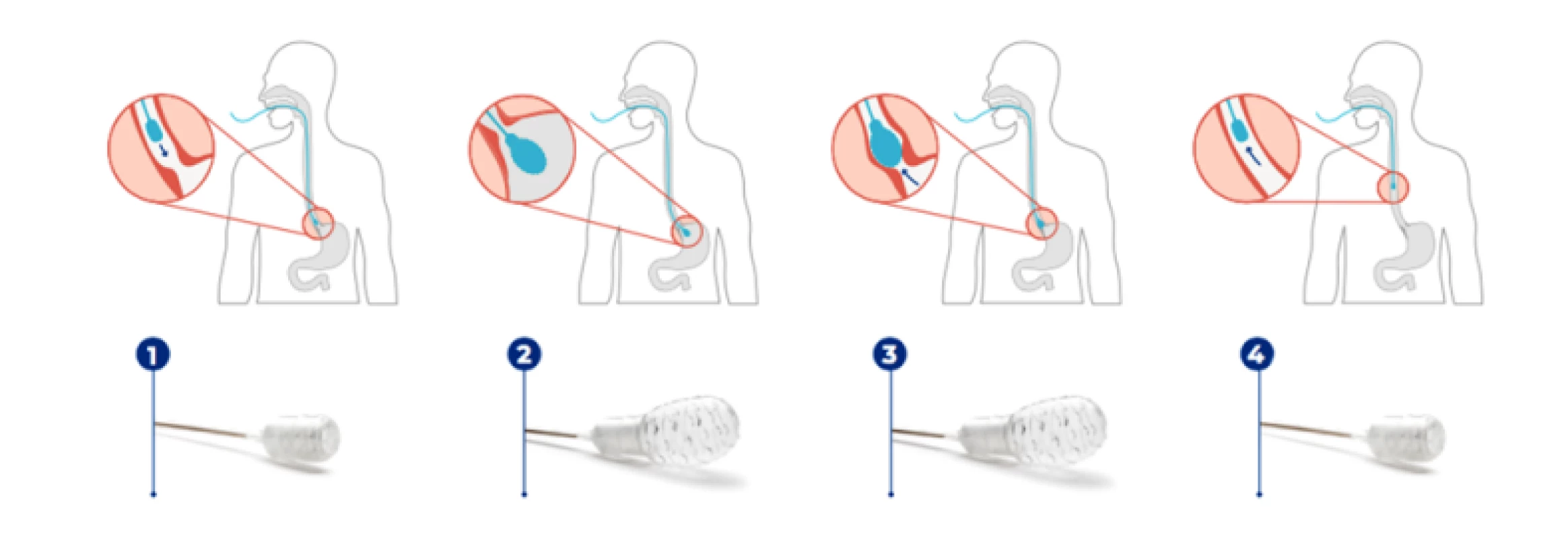 EsoCheck je spolknut (1), balónek je v žaludku nafouknut (2), pomocí orientačních značek na katetru je EsoCheck vytažen asi 5 cm proximálně od
gastroezofageální junkce (3), balónek je vyfouknut pro zabránění kontaminace a vyjmut (4) (14)
