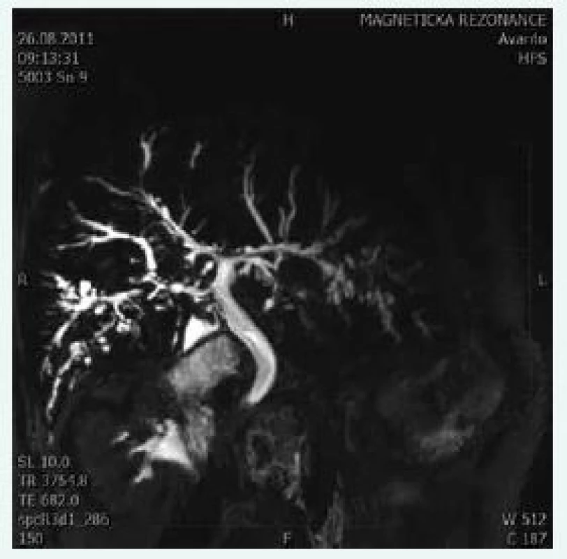 Cholangiogram u pacienta s PSC. Typické
změny zachycené při MRCP: vícečetné
segmentální striktury a dilatace žlučového
stromu s charakteristickým „korálkováním“