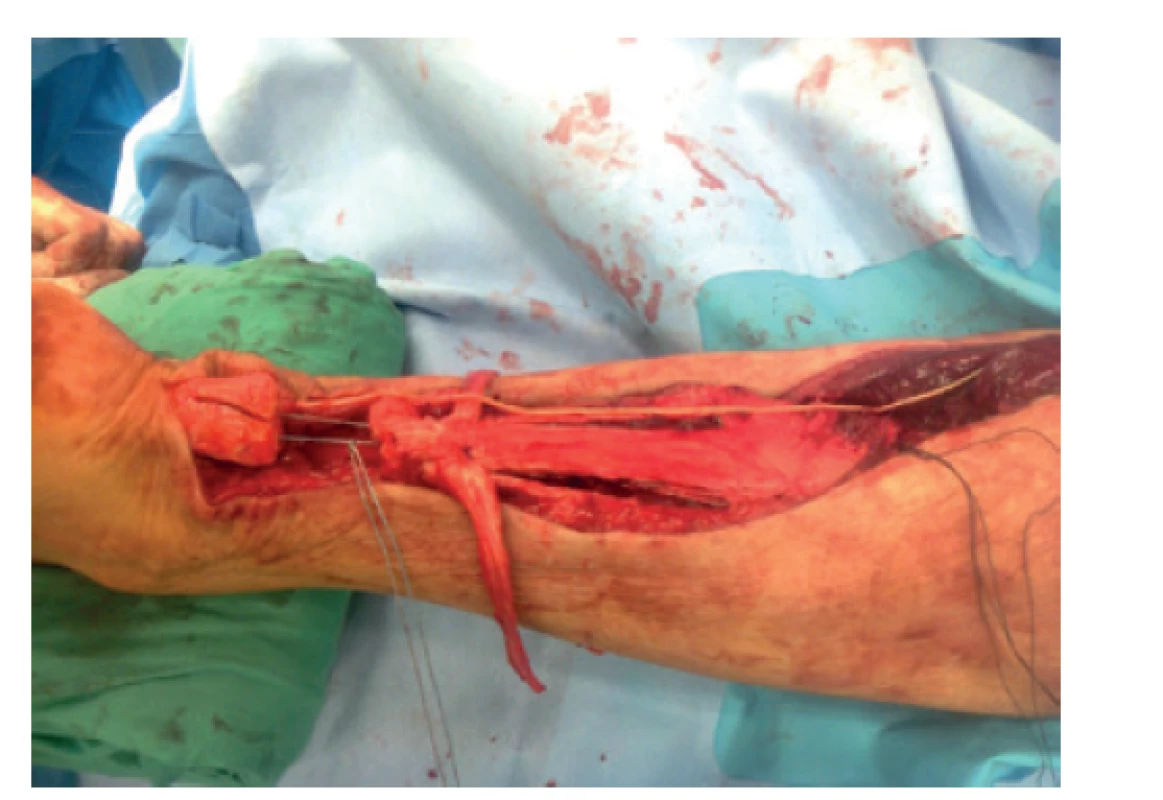Nedostatečné vyplnění defektu po V-Y plastice, připraveny
laloky dle Lindholma a m. plantaris k augmentaci<br>
Fig. 7: Incomplete defect closure after V-Y plasty; flaps according
to the Lindholm technique and plantaris muscle
prepared for augmentation