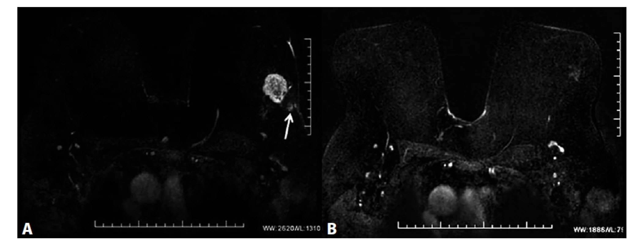 MRM, T1FS ax, kontrastní studie VIBRANT, 3. postkontrastní sekvence, subtrakce − ložiskové sycení ILC<br>
A) Před NCHT. Patologický ložiskový enhancement v HZK l. sin odpovídající ILC, satelitní léze dorzálně od tumoru (označeny
šipkou). B) Po NCHT. Výrazná regrese tumoru v HZK l. sin se snížením intenzity signálu. Satelitní léze nejsou patrné.<br>
Fig. 3: MRI, T1FS ax, VIBRANT contrast study, 3rd post-contrast sequence, subtraction − mass enhancement, ILC.<br>
A) Before NCT. Pathological mass enhancement in the UOQ in the left breast corresponding to ILC; satellite lesions
dorsally from the tumour (marked with the arrow). B) After NCT. Significant tumour regression in the UOQ of the left
breast with decreased signal intensity. Satellite lesions are not visible.