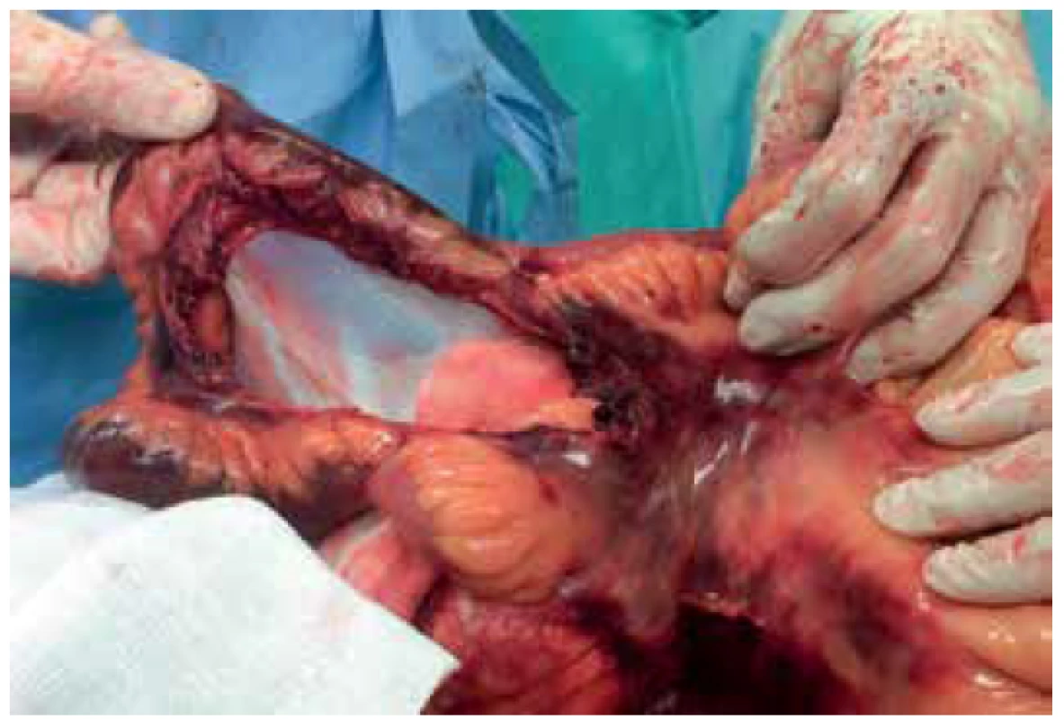 Poranění tenkého střeva grade V: avulze střeva<br>
Fig. 3. Small intestine injury grade V: avulsion