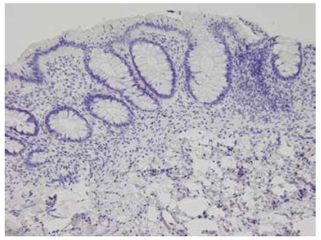 Negativní imunohistochemický průkaz kalretininu v lamina propria
i muscularis mucosae, HN (200x).