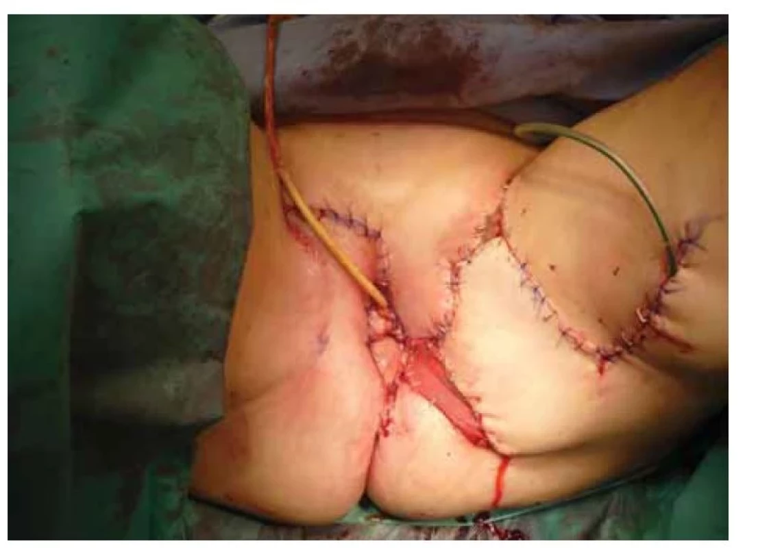 Stav po bezprostředně po rekonstrukci s krytím defektu fasciokutánními
laloky.<br>
Fig. 7. Condition immediately after reconstruction with covering of the defect
with fasciocutaneous flaps.