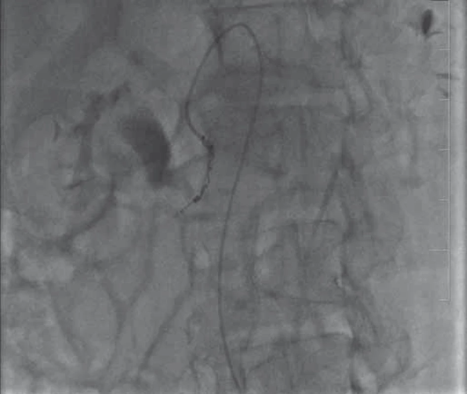 Angiografie – dva coily zavedené do poškozené
tepny.
Fig. 3. Angiography – two coils inserted into the affected
artery.