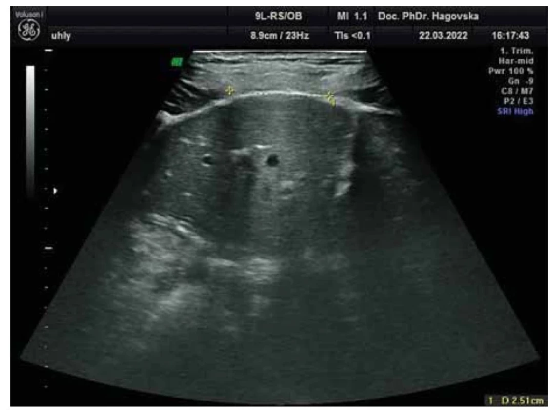 Vyšetrenie diastázy m. rectus abdominis 2D ultrazvukom.<br>
Fig. 2. Examination of the diastasis of m. rectus abdominis by 2D ultrasound.